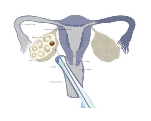 输卵管伞端粘连艾灸好用吗？输卵管伞端粘连如何治疗？